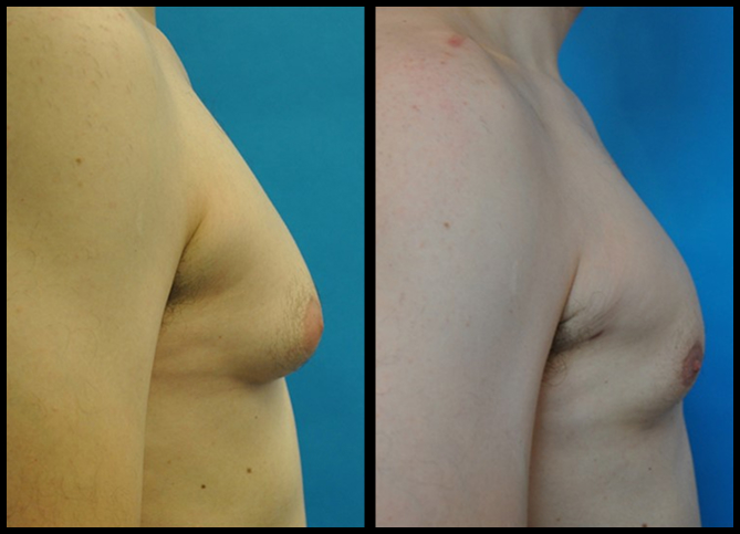 Before and After