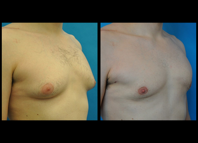 Before and After