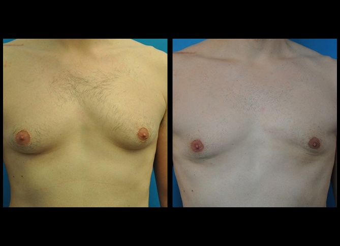 Before and After
