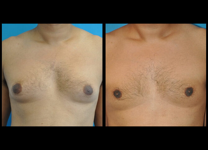 Before and After