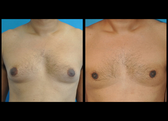 Before and After