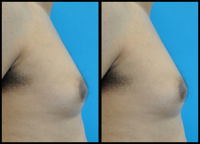 Before and After
