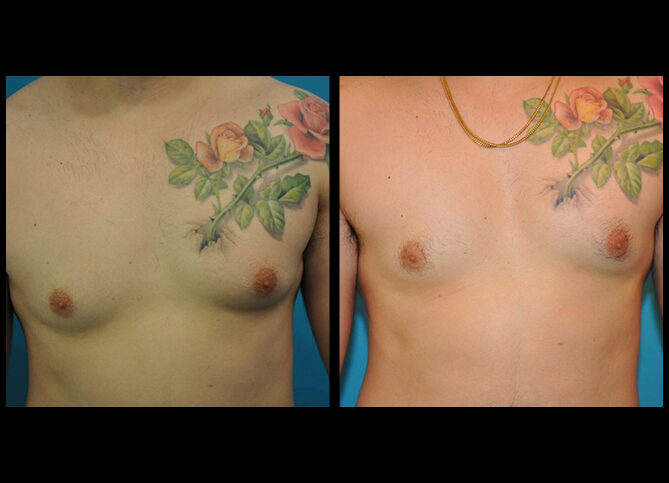 Before and After