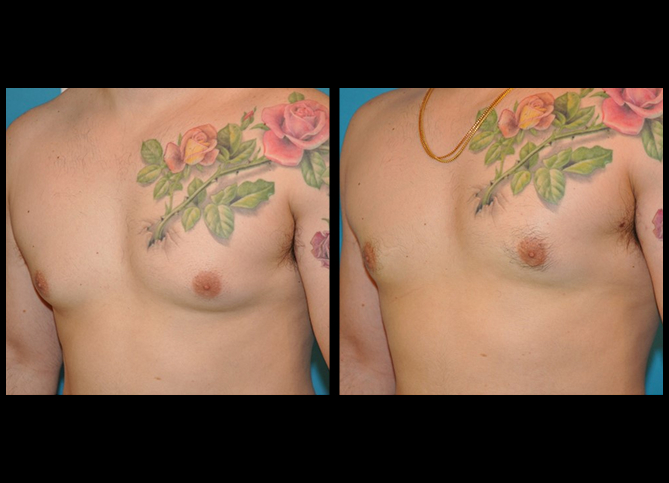 Before and After