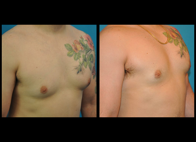 Before and After
