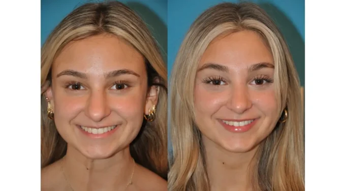 Before and After