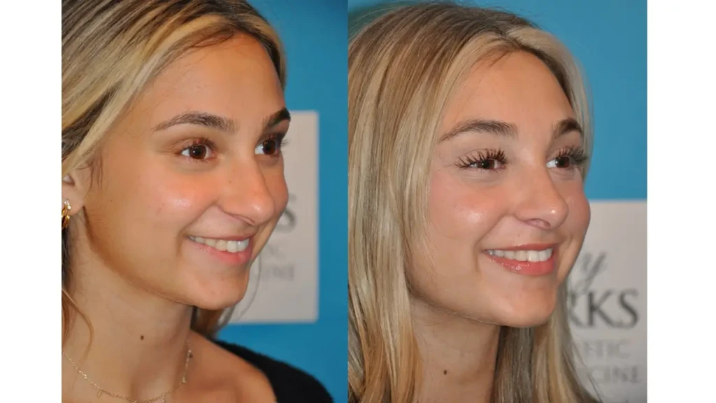 Before and After