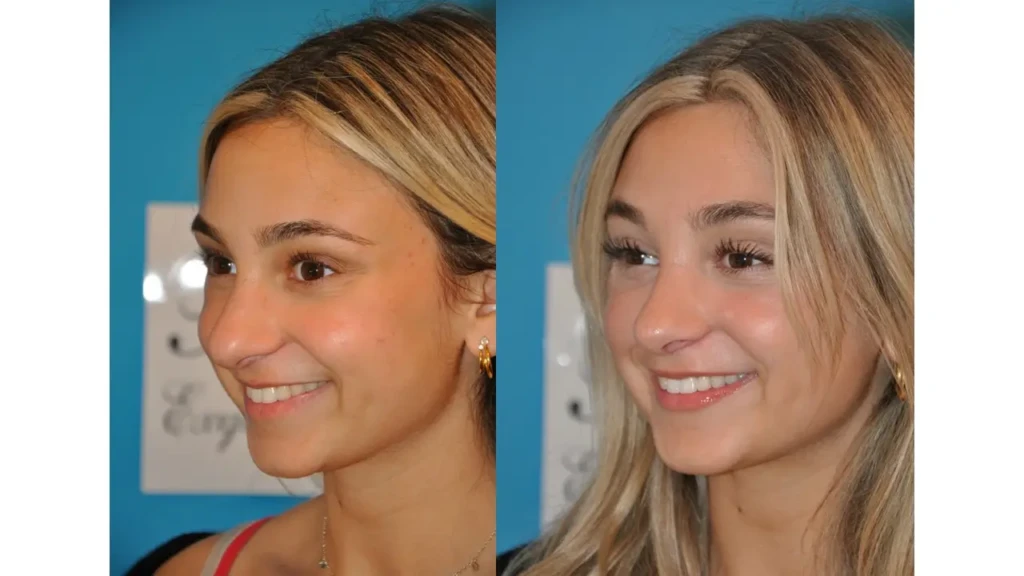 Before and After