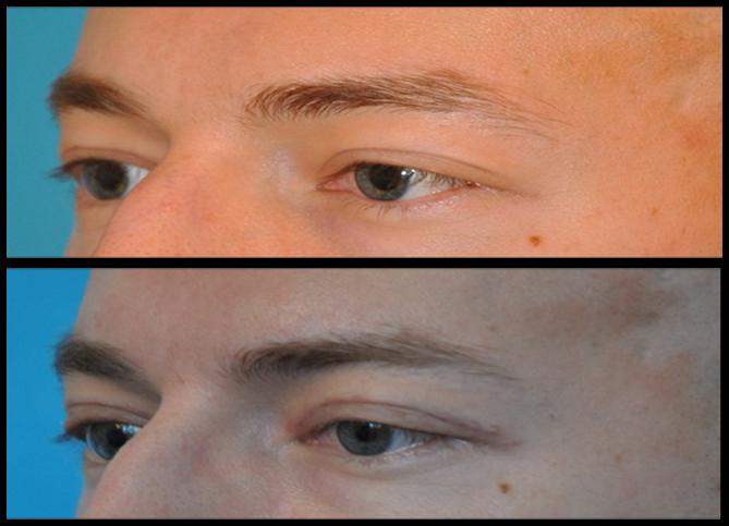 Before and After