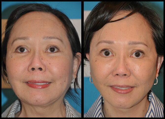 Before and After