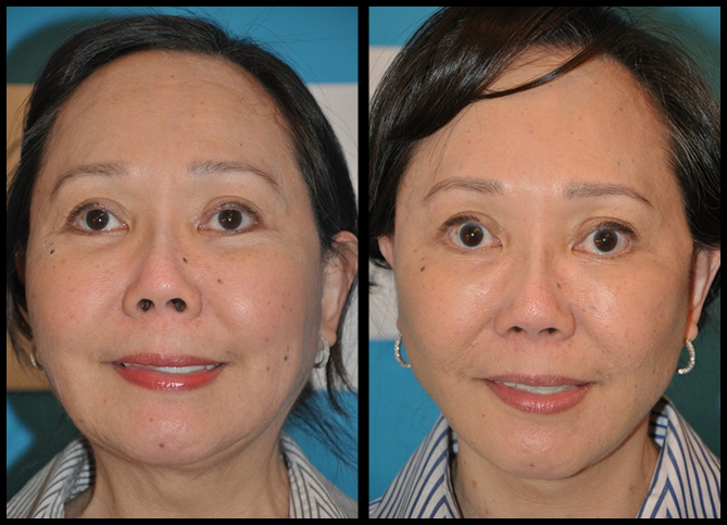 Before and After