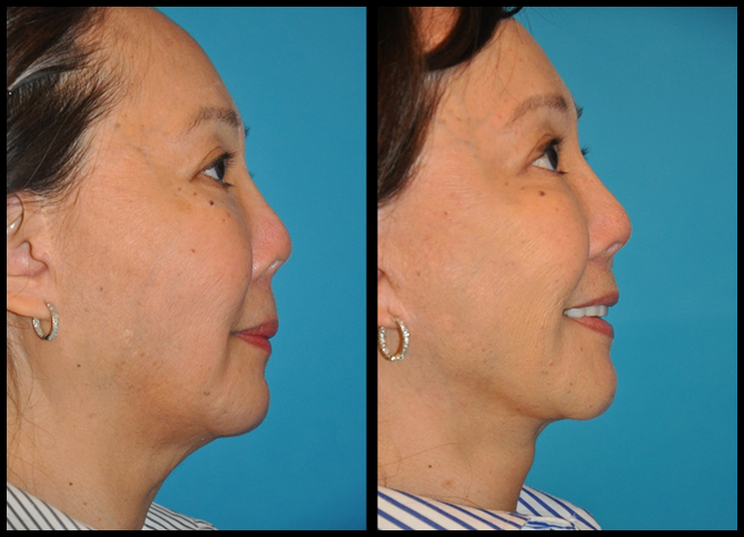 Before and After