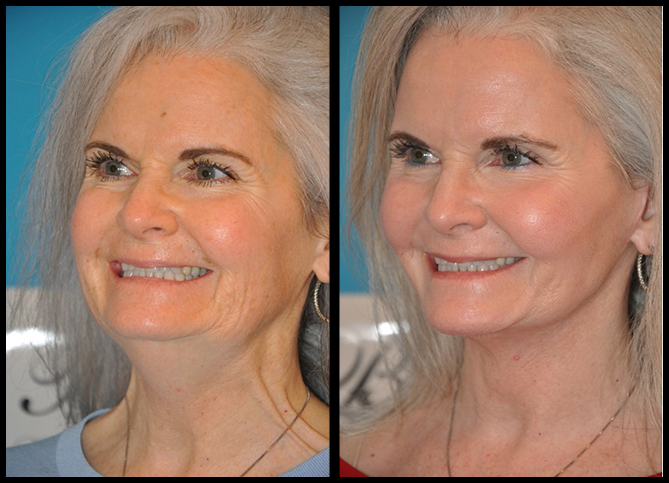 Before and After