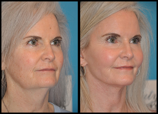 Before and After