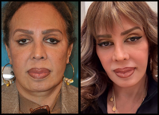 Before and After