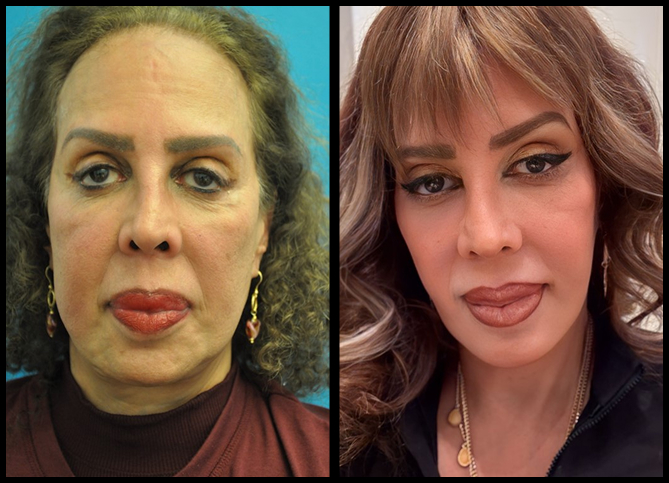 Before and After