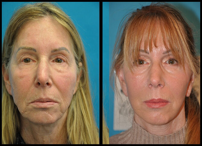 Before and After
