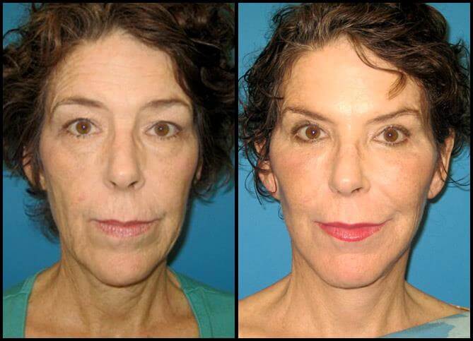 Before and After
