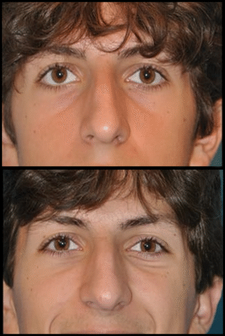 Before and After