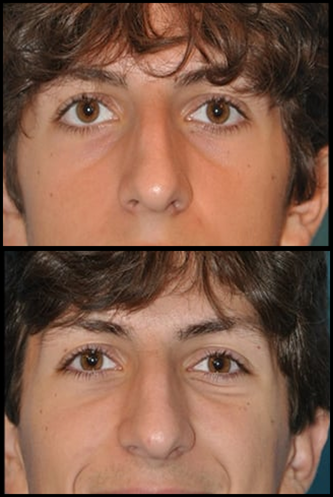 Before and After