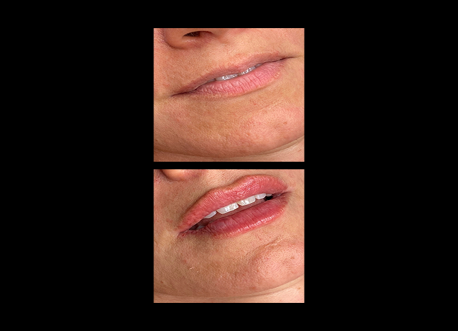 Before and After