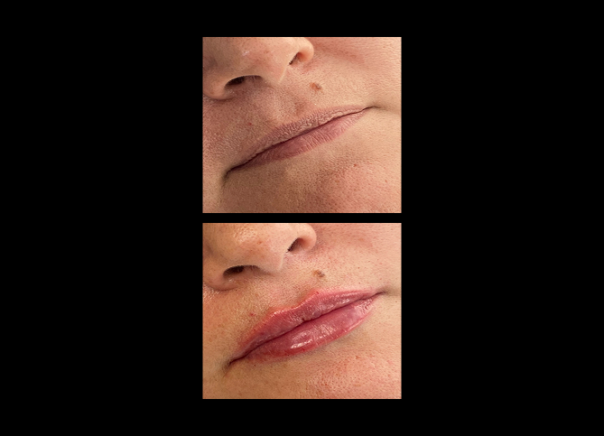 Before and After