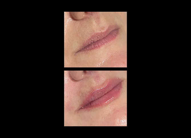Before and After