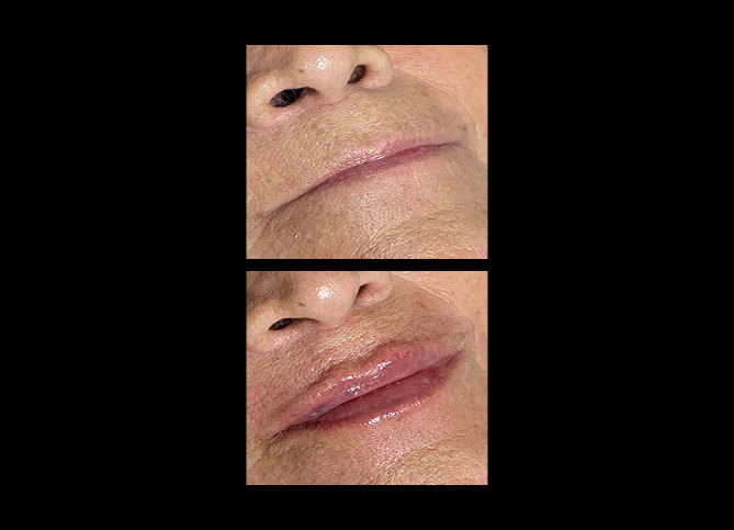 Before and After