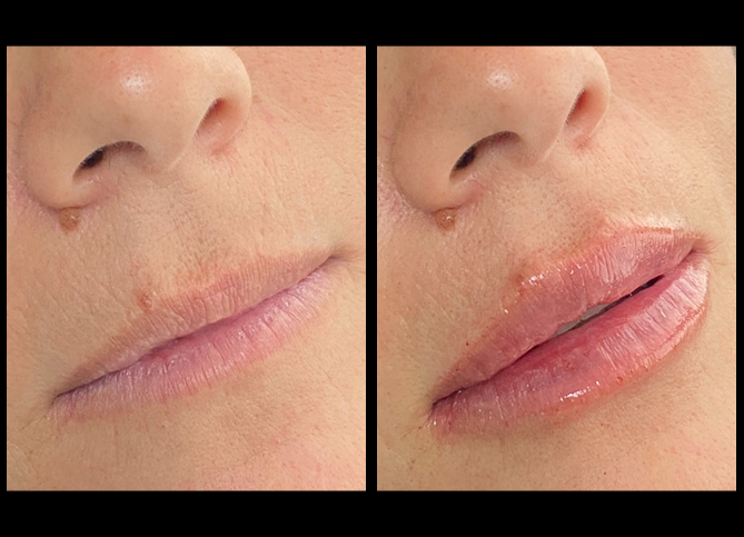 Before and After