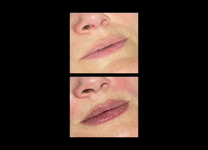Before and After