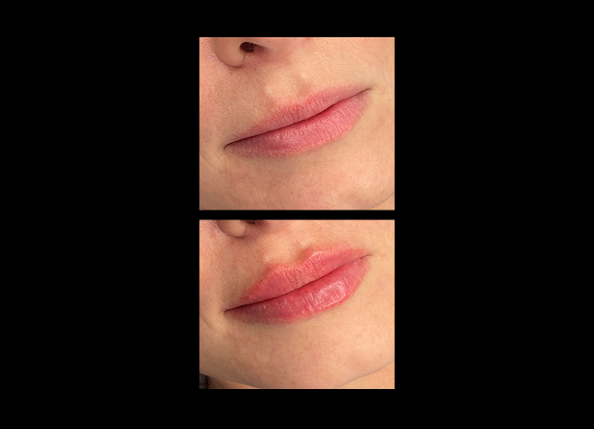 Before and After
