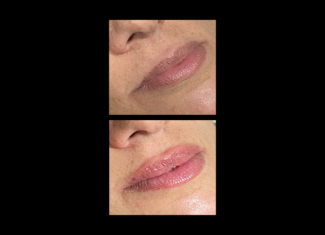 Before and After