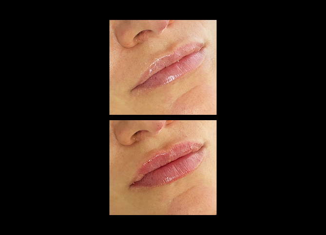 Before and After