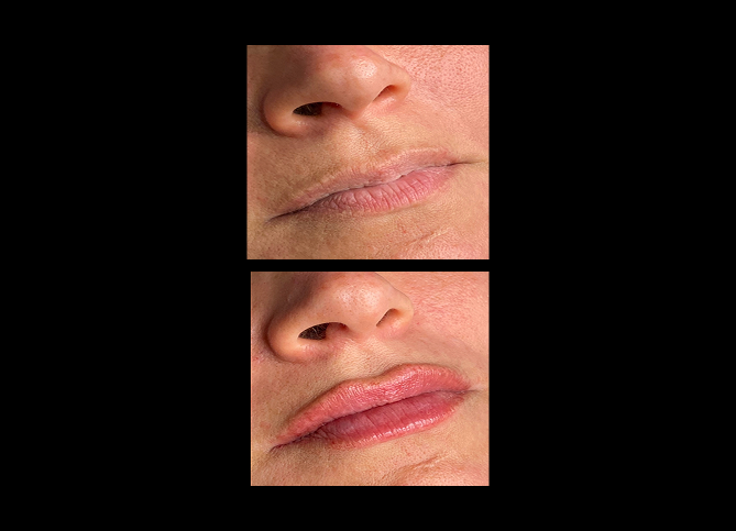 Before and After