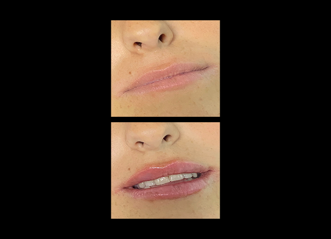 Before and After
