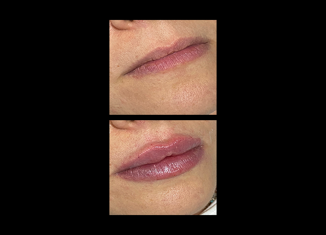 Before and After