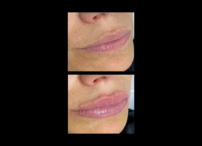 Before and After
