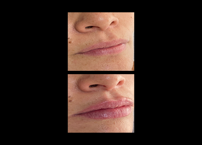 Before and After