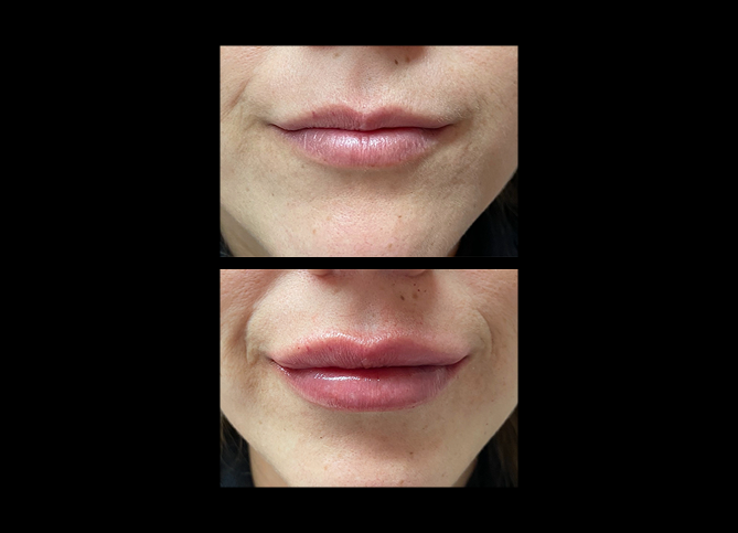Before and After