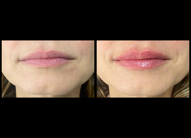 Before and After