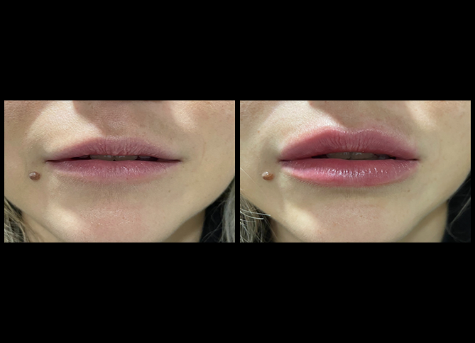 Before and After