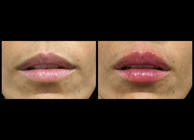 Before and After