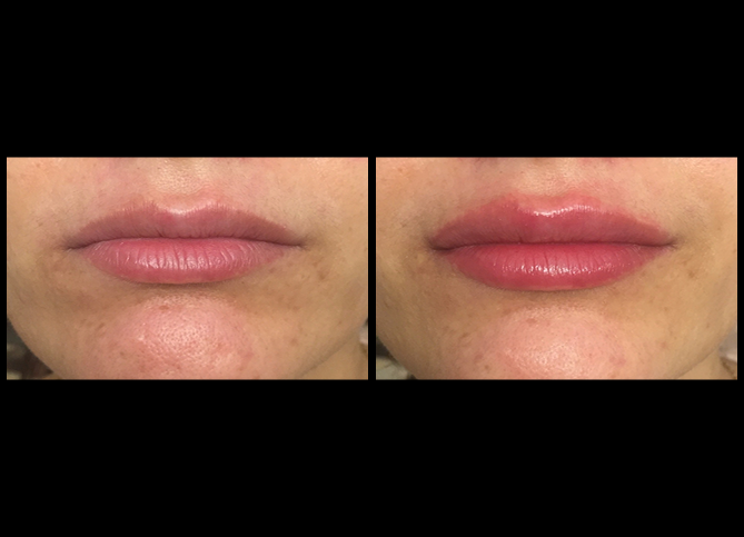 Before and After