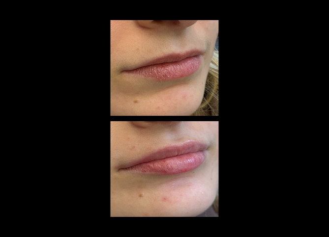 Before and After