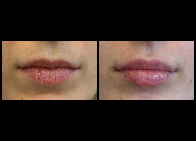 Before and After