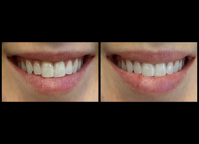 Before and After