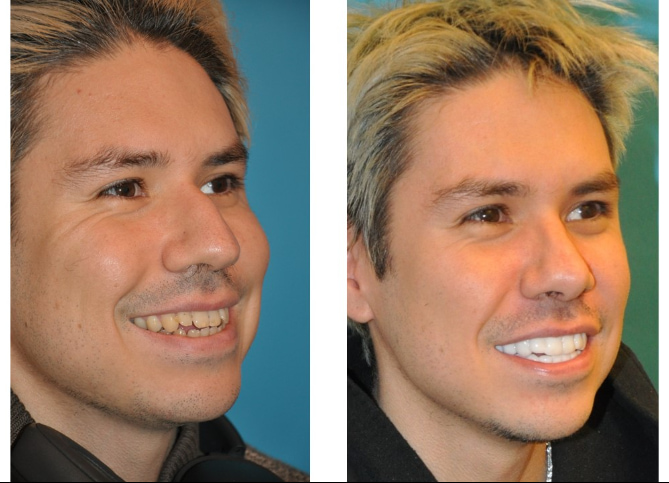 Before and After