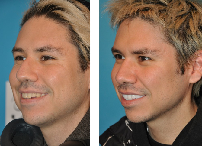 Before and After