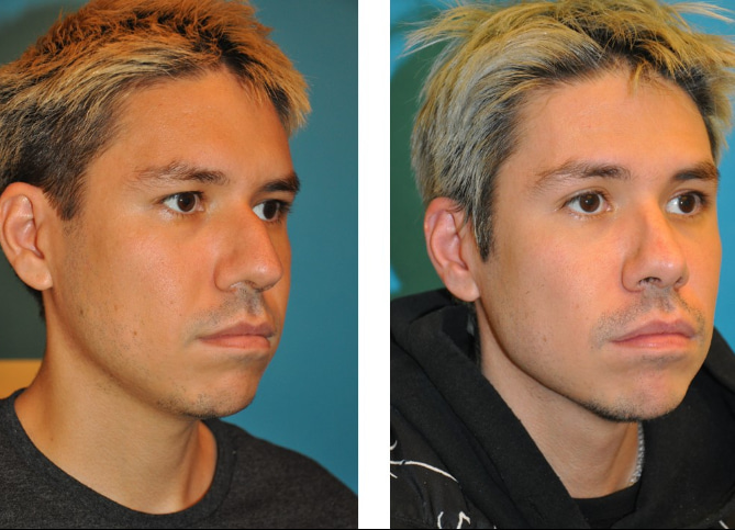 Before and After
