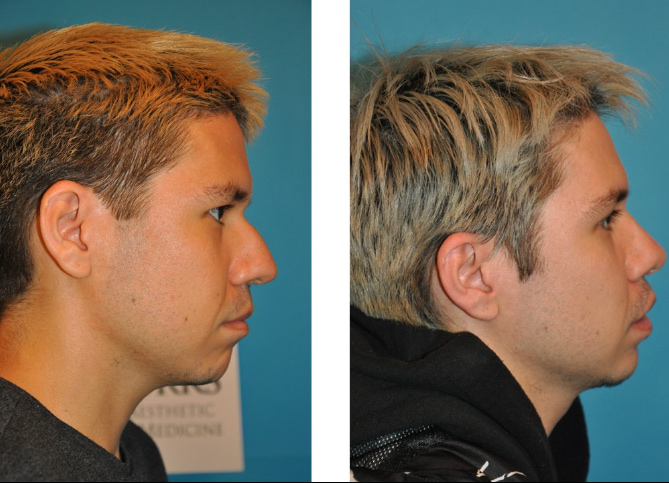 Before and After